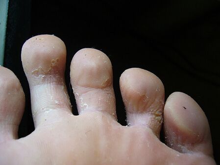 Peeling and flaking skin on the feet is a sign of fungus