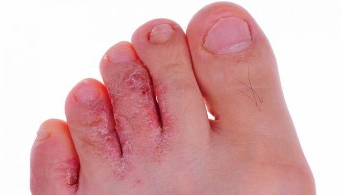 fungal infection on the skin of the toes