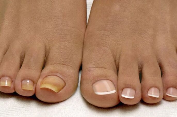 Fungus on the feet