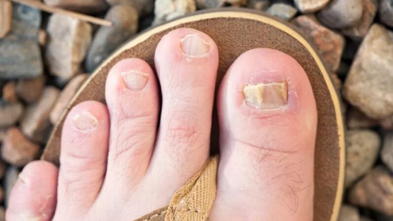 Nail mycosis