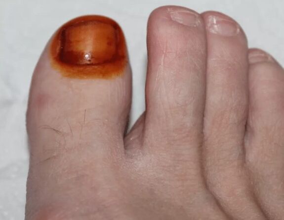 The treatment of iodine fungus