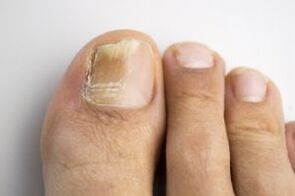 Disease with fungus