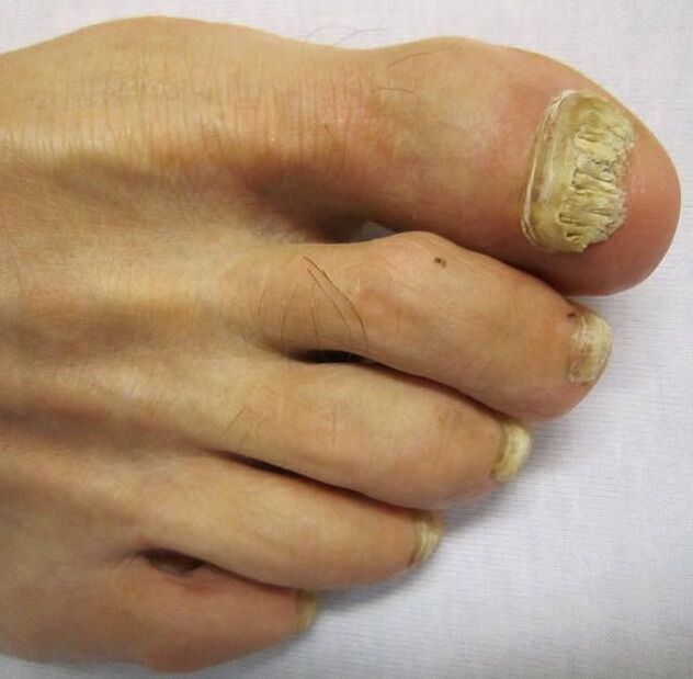 Damage to the nail plate