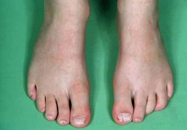 Fungus on the feet