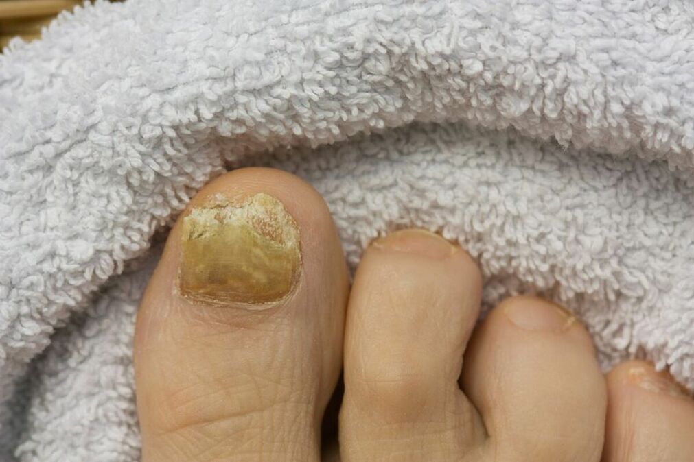 Atrophic stage of the fungus (falling from a piece of toenail)