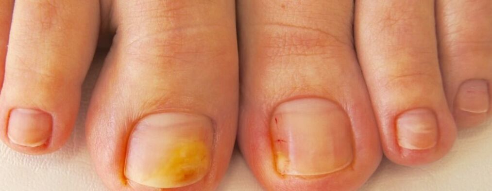 Early stage onychomycosis - yellowing of toenails