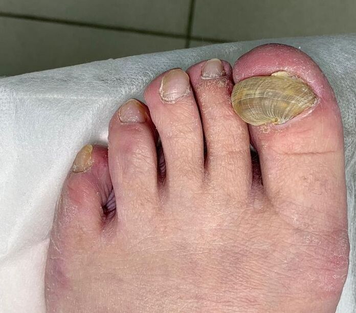 Hypertrophic onychomycosis of the feet - deformed nails