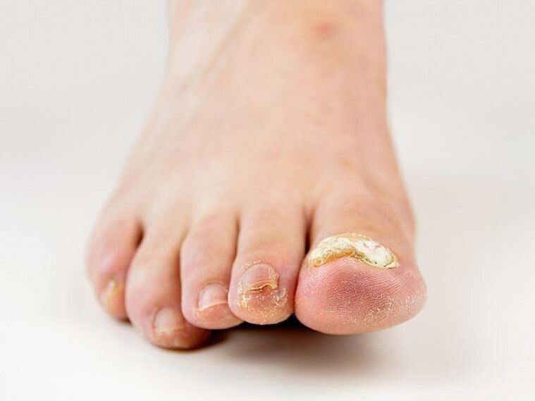 Thickening of the nail plate on the big toe with fungus