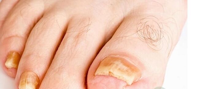 a variety of fingernails fungus
