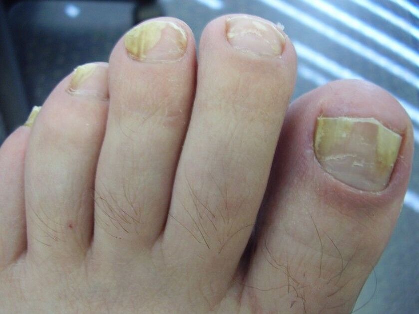 symptoms of toenail fungus