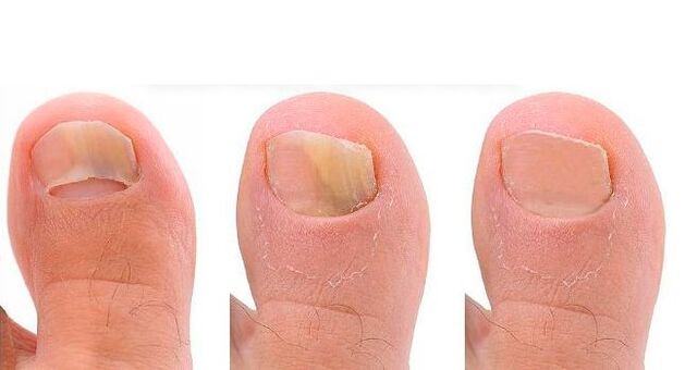 development stage of toenail fungus