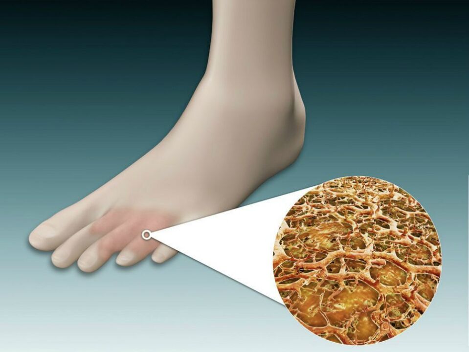 Redness of the skin between and near the toes with intertriginous fungus