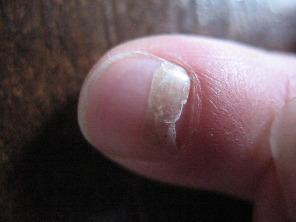 The type of onycholytic fungus is accompanied by detachment of the nail plate