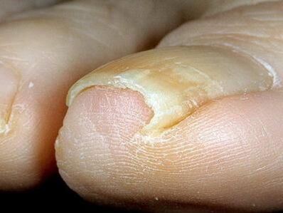 The appearance of toenails infected with fungus
