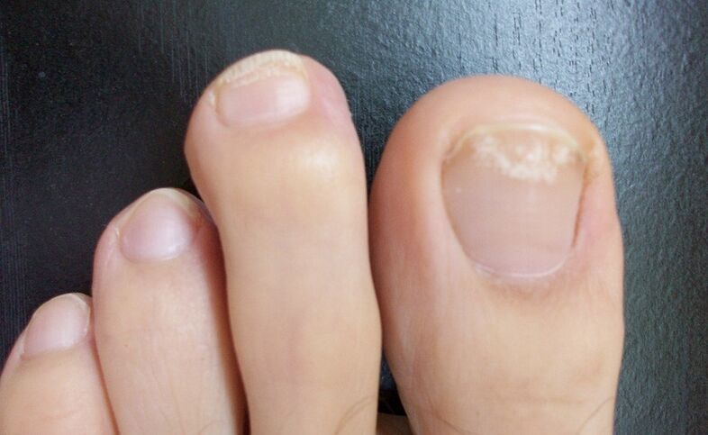 Early signs of fungus are changes in the color of the nail plate, the appearance of spots